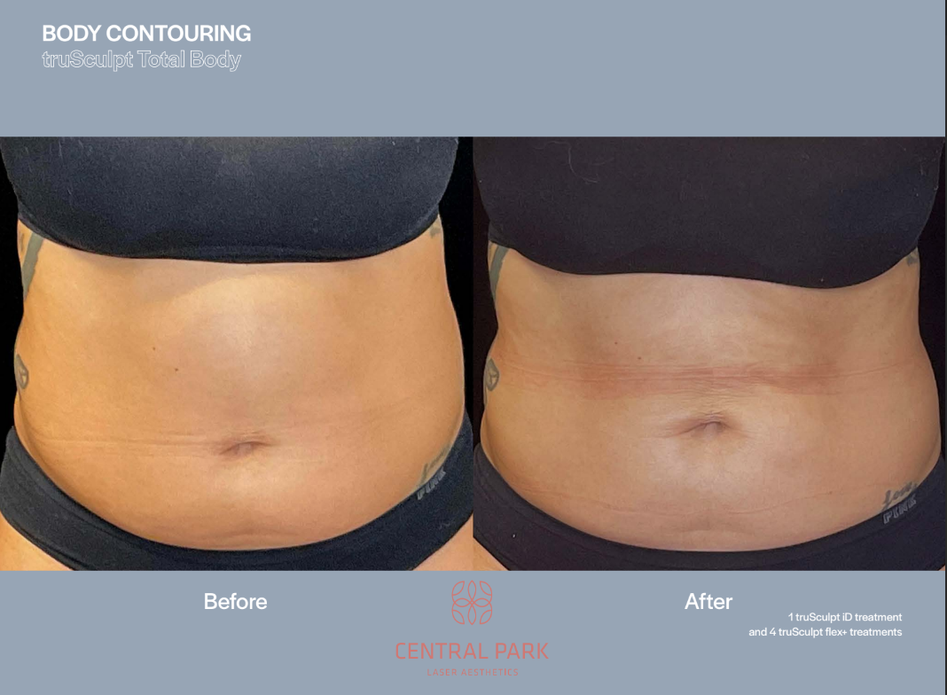 An advertisement for body contouring services, featuring before-and-after images of a person s abdomen after treatment.