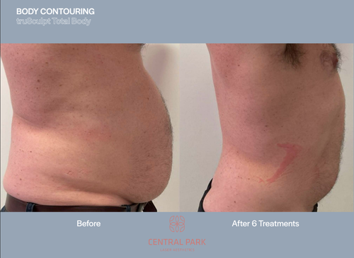 The image shows a before-and-after comparison of body contouring results, with the left side showing a person s back view of their abdomen before treatment and the right side showing the same area after six treatments, highlighting the improvement achieved by the procedure.