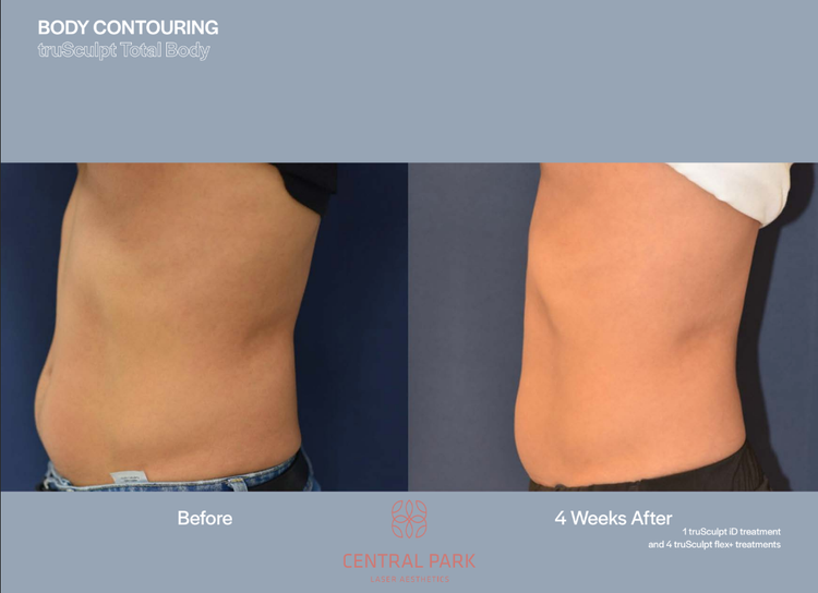 The image shows two side-by-side before-and-after photos of a person s body after a cosmetic procedure, likely a tummy tuck, with text indicating  Body Contouring  and a timeframe of  4 weeks.