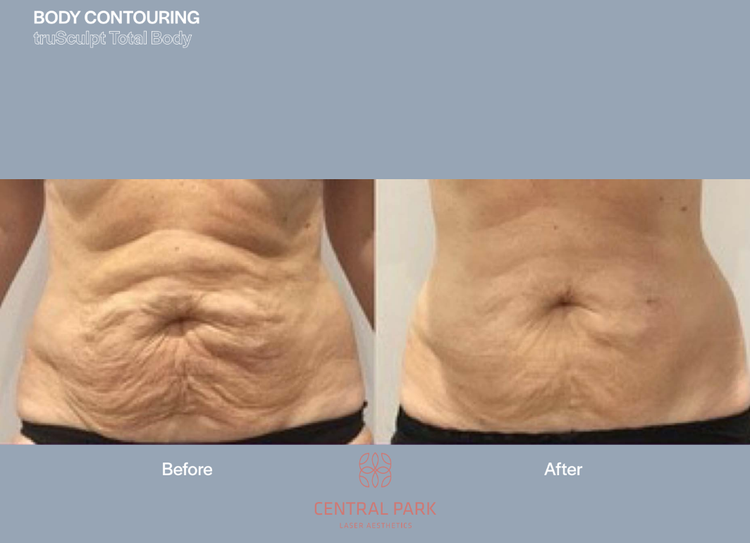 The image shows a before-and-after comparison of a body contouring procedure, with the left side showing a person s abdomen with visible fat deposits and the right side showing the same area after treatment, appearing smoother and more defined.