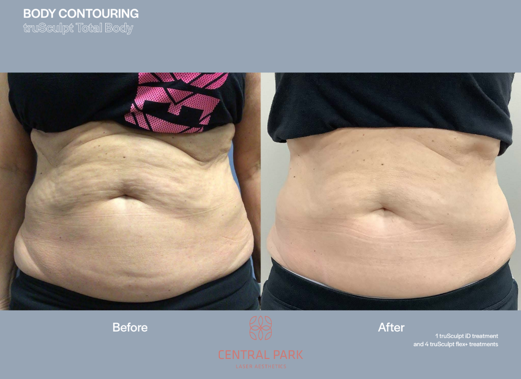 The image shows two photographs side by side, with the left photo showing a person s body before cosmetic surgery, and the right photo showing the same area after a cosmetic procedure, both focusing on body contouring, likely from a medical or healthcare context.