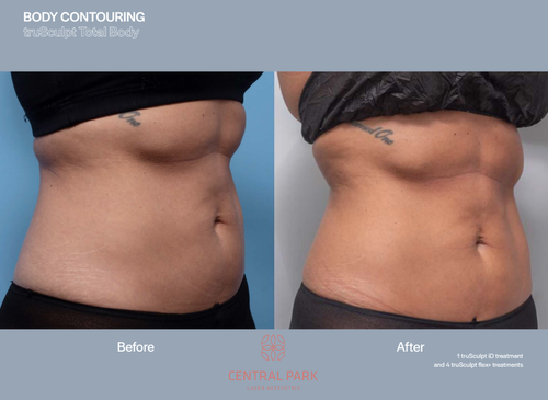 The image displays two side-by-side photographs of a person s abdomen before and after body contouring, showcasing the results of cosmetic surgery with visible fat reduction and muscle definition enhancement.