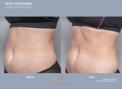 The image shows a before-and-after comparison of body contouring results, focusing on abdominal area improvement.