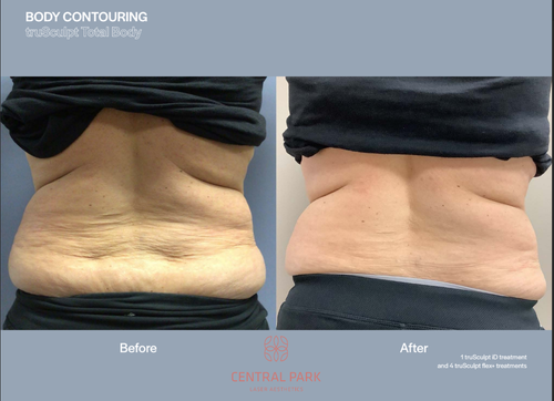 The image shows before-and-after photos of body contouring results, with visible surgical scars on the abdomen area, highlighting the transformation achieved through cosmetic procedures.