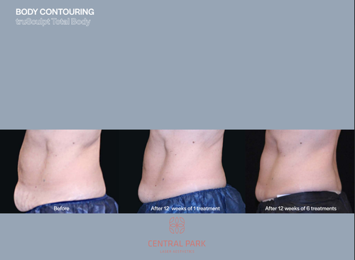 The image displays a collage of three photographs showing a person s body from different angles  a frontal view, a side view, and a back view, highlighting the results of a cosmetic procedure with text indicating  Body Contouring  and  10 weeks after surgery.