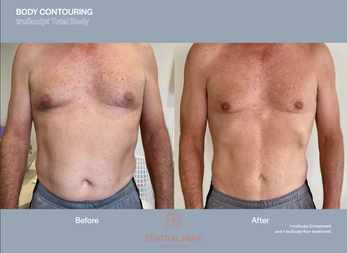 The image displays a before-and-after comparison of a body contouring procedure, showcasing the results of liposuction on an individual s abdomen.