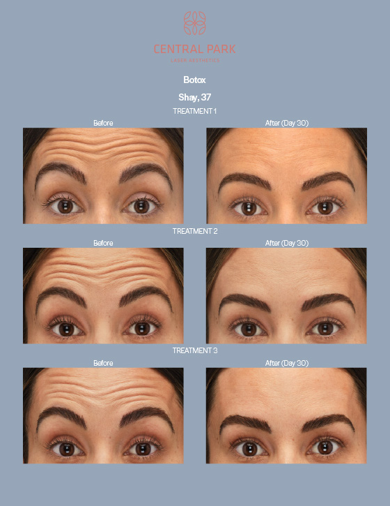 Central Park Laser Aesthetics | Botox For Migraines, Hyperpigmentation Treatment and DiamondGlow reg Medical Grade Facial