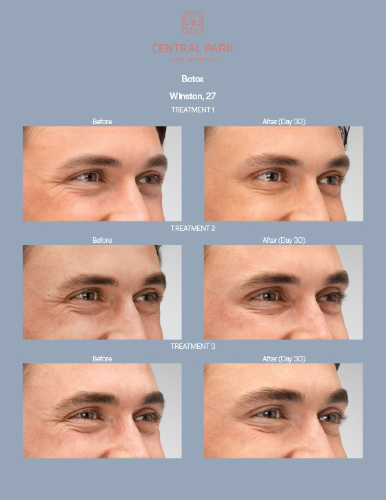 Central Park Laser Aesthetics | Botox, Masseter Botox For Teeth Grinding and Double Chin Treatment