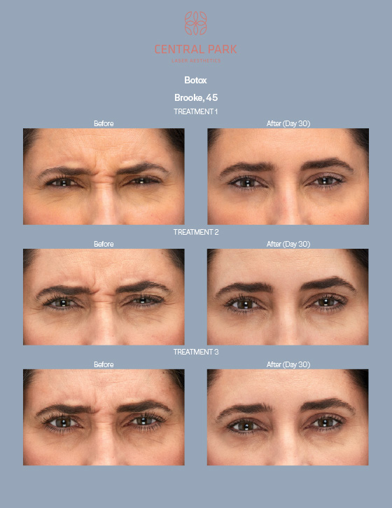 Central Park Laser Aesthetics | Laser Hair Removal, Botox For Sweating Treatment and Co2 Laser Resurfacing