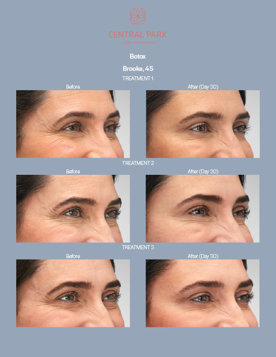 Central Park Laser Aesthetics | Hyperpigmentation Treatment, Excel reg V Laser Genesis and Acne Treatment
