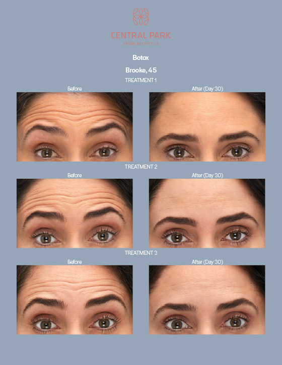 Central Park Laser Aesthetics | Acne Scar Treatment, SKINVIVE and Chemical Peel Treatment