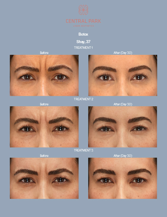 Central Park Laser Aesthetics | Sun Spots Treatment, Masseter Botox For Teeth Grinding and Injectables