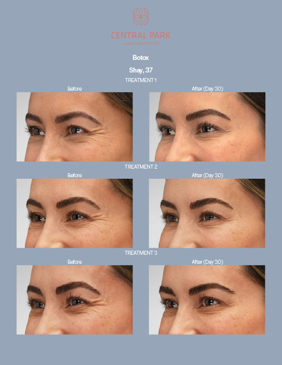 Central Park Laser Aesthetics | Laser Hair Removal, Secret PRO and Sun Spots Treatment