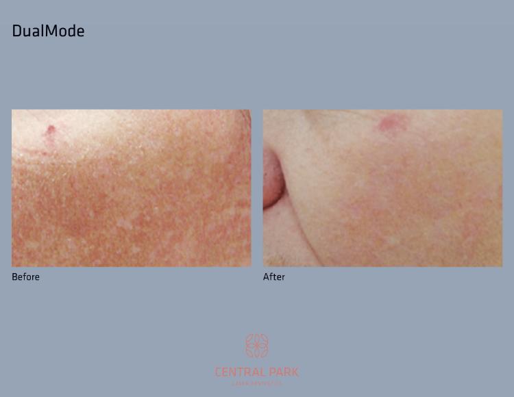Central Park Laser Aesthetics | Chemical Peel Treatment, Dermal Fillers and Tattoo Removal