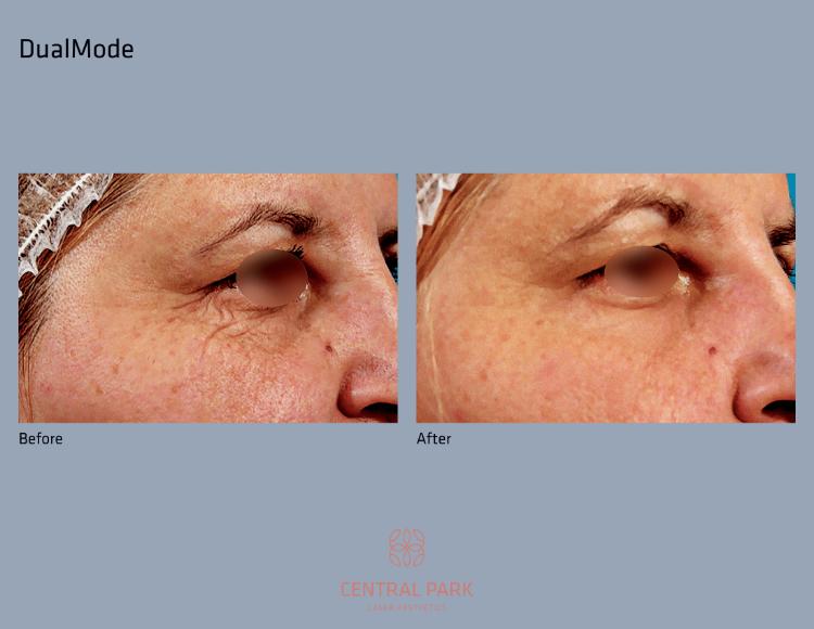 Central Park Laser Aesthetics | Tattoo Removal, Glass Facial and Botox