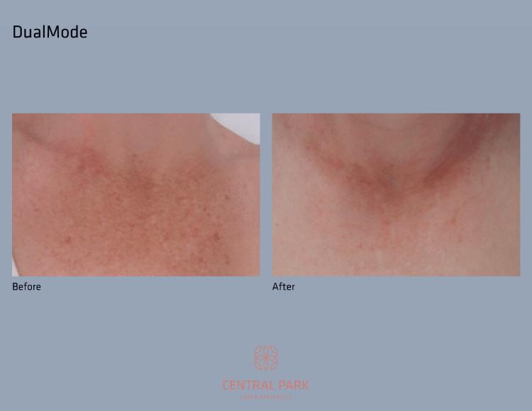 Central Park Laser Aesthetics | Botox, Masseter Botox For Teeth Grinding and Double Chin Treatment