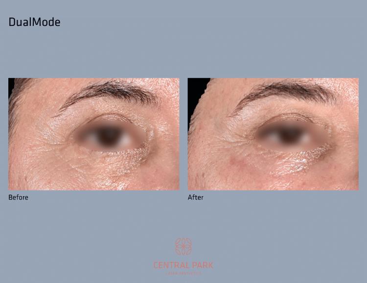 Central Park Laser Aesthetics | Dark Spots Treatment, Tattoo Removal and KeraDuo Hair Regrowth