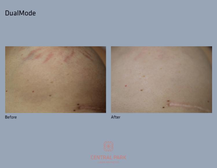 Central Park Laser Aesthetics | Laser Hair Removal, Botox For Sweating Treatment and Co2 Laser Resurfacing