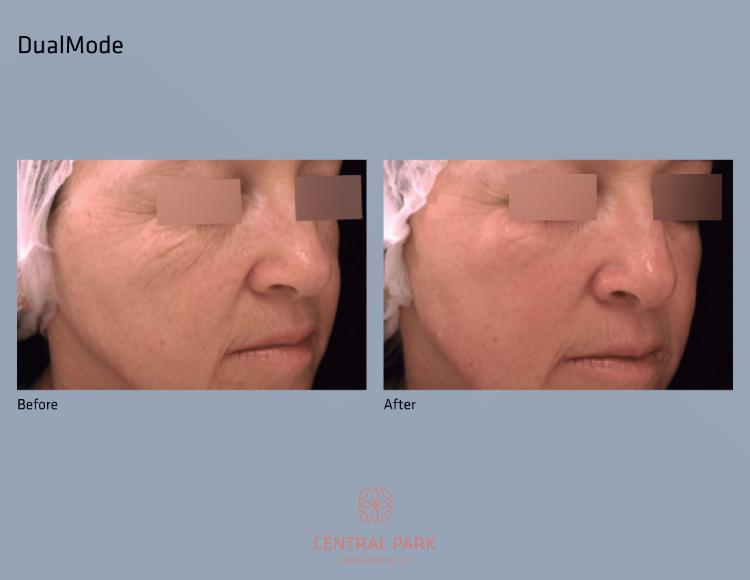 Central Park Laser Aesthetics | Acne Scar Treatment, SKINVIVE    and Chemical Peel Treatment