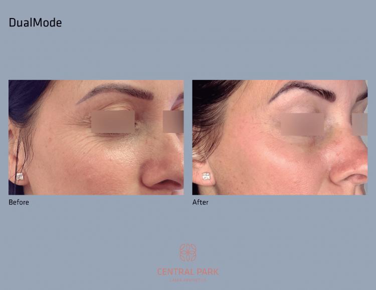 Central Park Laser Aesthetics | Sun Spots Treatment, Masseter Botox For Teeth Grinding and Injectables