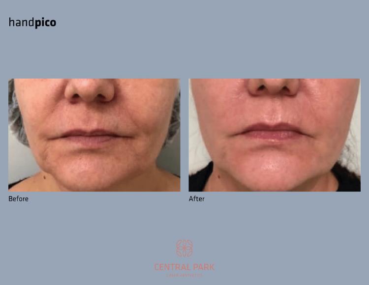 Central Park Laser Aesthetics | Chemical Peel Treatment, Dermal Fillers and Tattoo Removal
