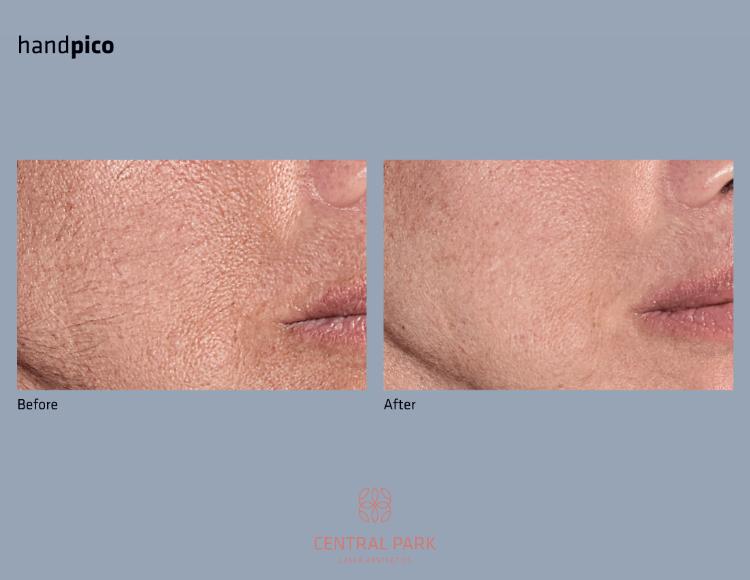 Central Park Laser Aesthetics | Tattoo Removal, Glass Facial and Botox