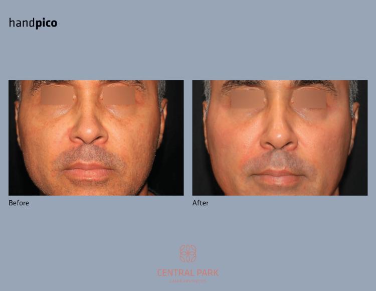 Central Park Laser Aesthetics | Botox, Masseter Botox For Teeth Grinding and Double Chin Treatment