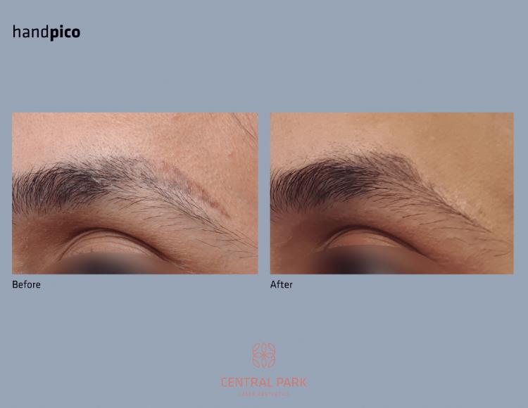 Central Park Laser Aesthetics | Dark Spots Treatment, Tattoo Removal and KeraDuo Hair Regrowth