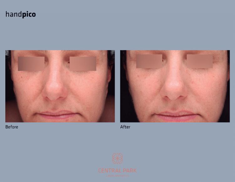 Central Park Laser Aesthetics | Laser Hair Removal, Botox For Sweating Treatment and Co2 Laser Resurfacing