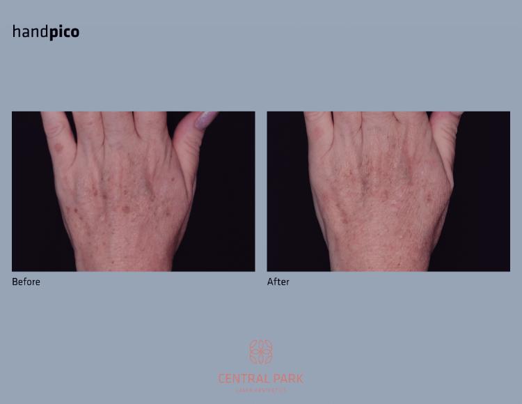 Central Park Laser Aesthetics | Hyperpigmentation Treatment, Excel reg  V    Laser Genesis and Acne Treatment