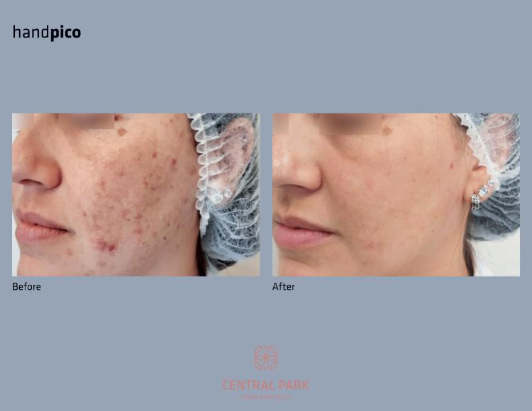 Central Park Laser Aesthetics | Acne Scar Treatment, SKINVIVE    and Chemical Peel Treatment