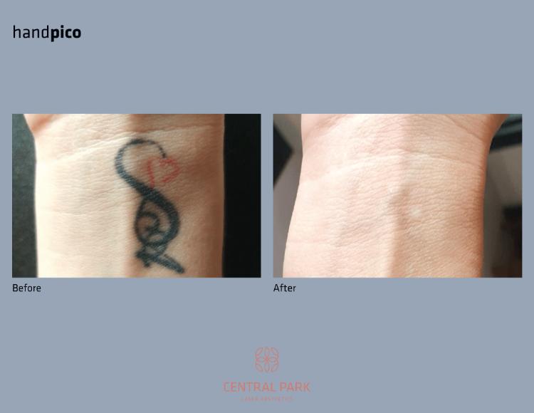 Central Park Laser Aesthetics | Sun Spots Treatment, Masseter Botox For Teeth Grinding and Injectables