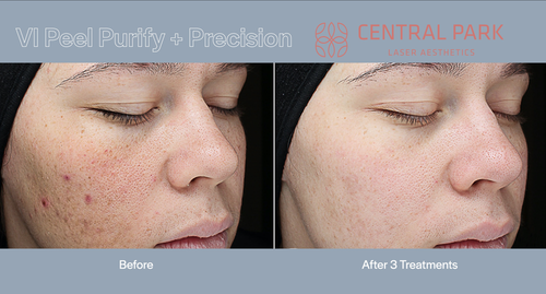 The image shows a before-and-after comparison of skin treatments, with visible improvements in skin texture and tone after three sessions of treatment.