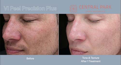The image displays two side-by-side photographs of a person s face showing before and after results of a cosmetic treatment, likely a peel, with text indicating VI Peal Procedure Plus and Central Park Laser Skin Care.