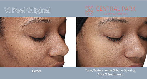 The image shows a split-screen comparison of a person s skin before and after a cosmetic treatment, with text indicating an improvement in texture and scarring.