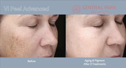 The image shows a before-and-after comparison of a person s skin after receiving treatment at Central Park Medical Aesthetics, with visible improvements to skin texture and tone.