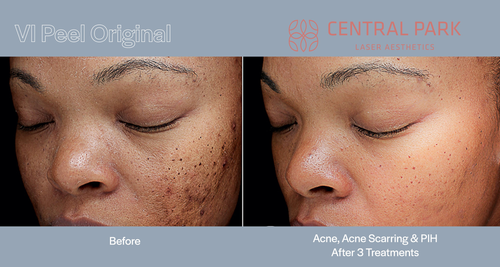 The image shows a before-and-after comparison of skin treatments, featuring two photographs side by side with a woman s face and neck, highlighting visible improvements after acne scarring removal.