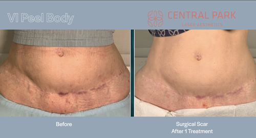 The image displays two photographs side by side of a person s abdomen before and after treatment, showcasing the results of a surgical scar on their lower torso.