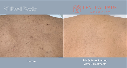 The image shows a before-and-after comparison of a skin treatment, with the left side showing a person s back with visible acne and the right side showing the same area after treatment, appearing clearer.