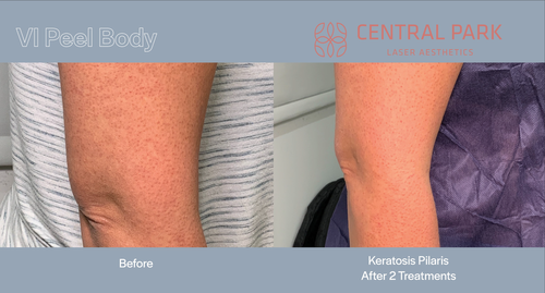 The image shows two before-and-after photos of a cosmetic treatment, likely related to skin rejuvenation or body contouring, with visible text indicating a KERATOSIS PILARIS treatment and an advertisement for VI PEEL BODY .