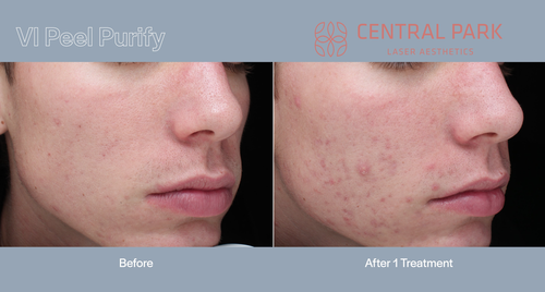 The image displays before-and-after photos of skin treatment, showcasing the results of a peel purity treatment at Central Park.