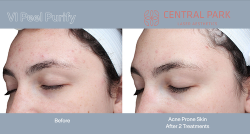 The image shows a comparison between a person s skin condition before and after treatment with VI Peel Purity, highlighting the results of acne treatments at Central Park.
