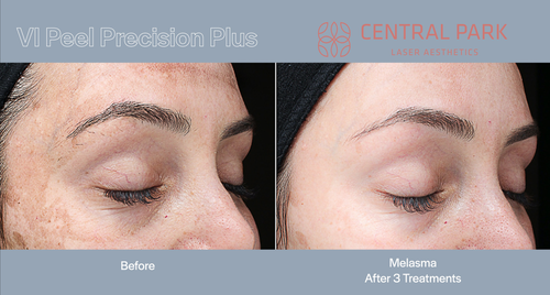 The image displays before-and-after pictures of a cosmetic treatment, showcasing the results of a laser skin resurfacing procedure at a clinic named VIP Peel.