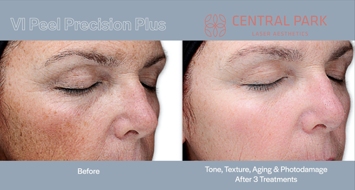 The image shows a collage of two photographs an initial close-up of a person s skin with visible blemishes, and a subsequent close-up after treatment, showcasing improved skin texture and reduced blemishes.