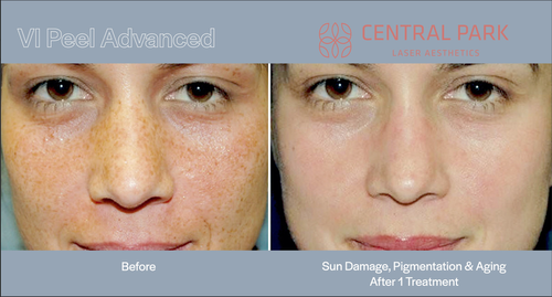 The image shows a side-by-side comparison of a person s skin before and after a treatment, highlighting the results of a cosmetic procedure at Central Park Laser Clinic.