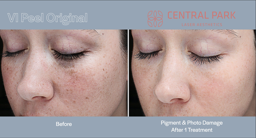 The image shows before-and-after treatment photos with text indicating VI Peel Original and Central Park Laser Skin Care.