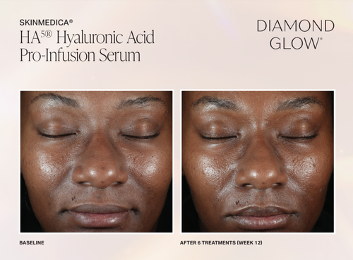The image displays a before-and-after comparison of a person s skin condition after using a product from the brand  HA HYDRONIC ACID PRO-INFUSION SERUM.