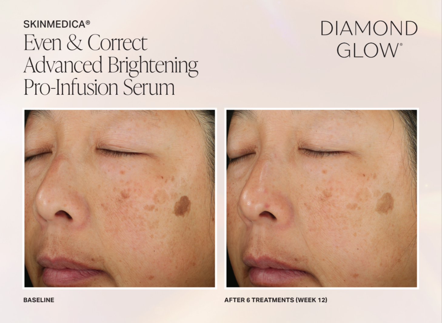 The image displays a before-and-after comparison of skin treatments, showcasing a person s face with advanced brightening Pro-Infusion Serum.