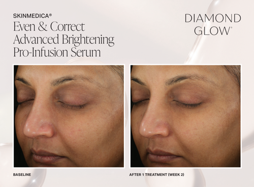 The image displays two side-by-side photographs of a person s face with visible cosmetic treatment results, showcasing advanced brightening pro-infusion serum before and after application.