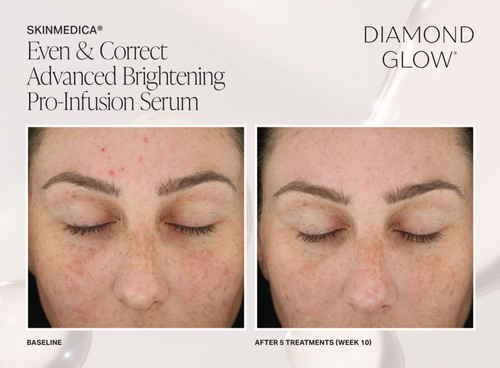 The image shows a before-and-after comparison of a person s skin condition, with the left side showing an unclear complexion and the right side displaying clearer skin after treatment. It appears to be an advertisement for a skincare product or service, specifically mentioning  advanced brightening pro-infusion serum.  The brand name  DIAMOND GLOW  is visible, suggesting it s the name of the product or service being advertised.